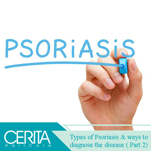 Types of psoriasis